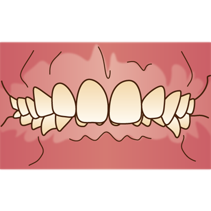 過蓋咬合(上の歯の覆いすぎ)