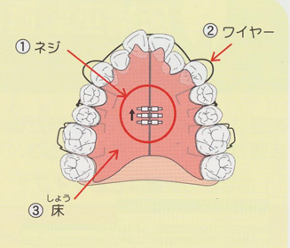 床矯正