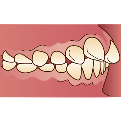 上顎前突(上の歯の突出)